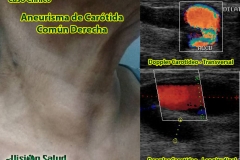 aneurisma-carotideo