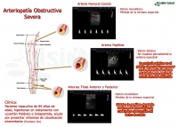 Arteriopatía Obstructiva Severa de Miembros Inferiores