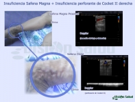 Presentación Atípica de Insuficiencia Safena Magna