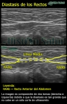 Diastasis de los Rectos Anteriores del Abdomen