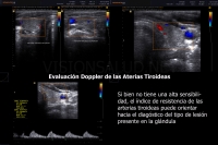 Doppler Arterias Tiroideas