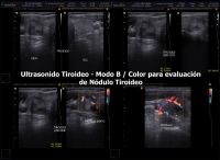 Ultrasonido Doppler Tiroideo