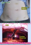 Reparación de Hernia Epigástrica por Laparoscopia