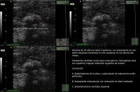 Placa de Ateroma en Bulbo Carotídeo