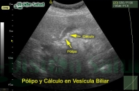 Vesícula Biliar - Cálculos y Pólipo