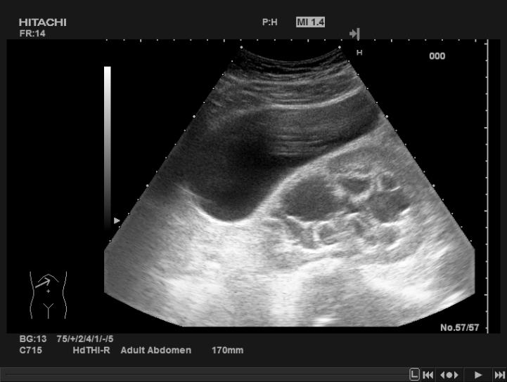 Diagnóstico avanzado por ultrasonido abdominal