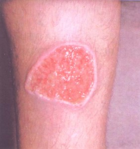 Ulcera por Leishmaniasis Cutánea