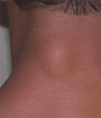Lipoma en la región posterior del cuello (nuca)
