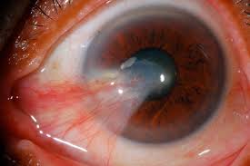 Las carnosidades en el ojo pueden quitarle la visión a un paciente