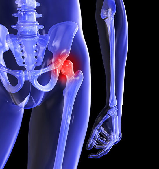El dolor de cadera puede ser por osteoartrosis o incluso fracturas de cadera