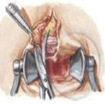 Cirugía de la fisura analCirugía de la fisura anal