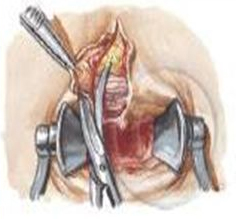 Cirugía de la fisura analCirugía de la fisura anal