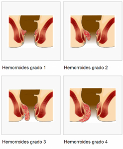 Clasificación de las Hemorroides