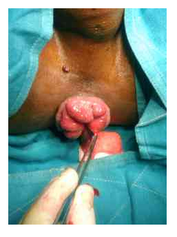 Cirugía de Hemorroides