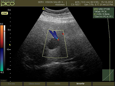 Imagen de ultrasonido abdominal con efecto doppler en región hepática