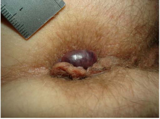 Paciente con trombosis hemorroidal