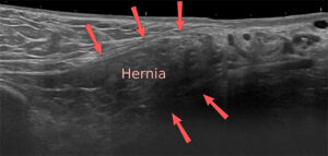 Imagen de ultrasonido de partes blandas que muestra una hernia inguinal