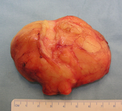 Imagen de un lipoma
