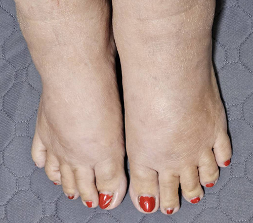 Foto de pies con edema